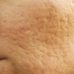 Бугристая кожа лица - причины и лечение в домашних условиях