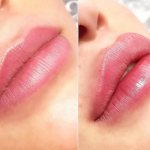 Herpes after lip augmentation