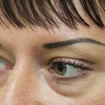lower eyelid hernia
