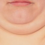 Double chin correction at the Gradient clinic