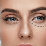 Laser blepharoplasty. Reviews of operated lower and upper eyelids, how they do it. Prices 