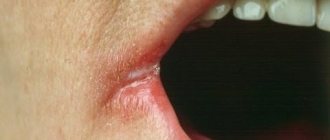 Why lips crack, dry and peel - causes and treatment of dry skin in women and men