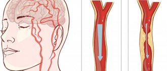 Causes of stroke