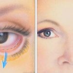 Sagging lower eyelid after blepharoplasty
