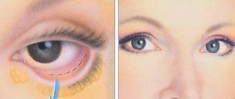 Sagging lower eyelid after blepharoplasty