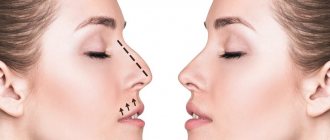 rhinoplasty of girls opposite each other with a dotted line on the nose