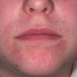 Rash on the chin in women: causes and rashes, treatment methods