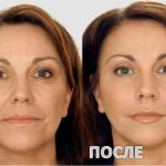 Injections with hyaluronic acid for the face. Photos of the results of injections under the eyes, contraindications 