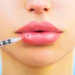 Увеличение губ гиалуроновой кислотой — болезненная